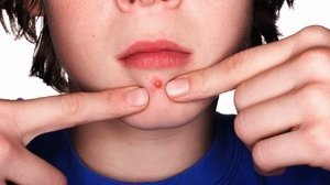 Простудні прищі: види прищів на обличчі і їх лікування, причини утворення