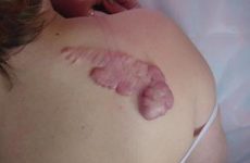 Причини, за якими з’являється колоїдний рубець або шов, методи лікування і профілактики виникнення шрамів