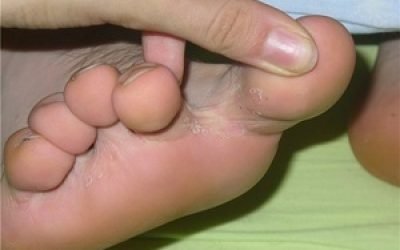 Поява грибка на шкірі між пальцями ніг: причини та симптоми, методи лікування мікозу та профілактика