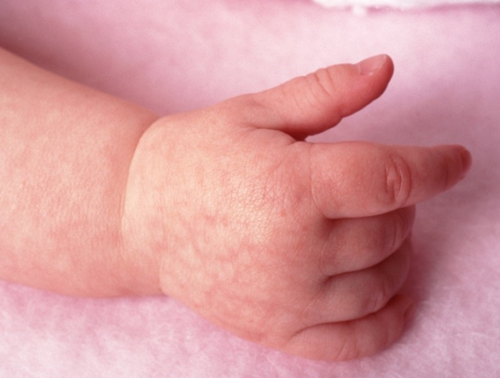 Атопічний дерматит у немовлят: причини, ефективне лікування