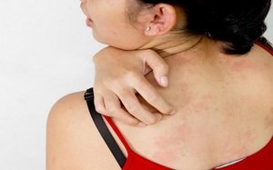 Шкірний дерматит: різновиди у дорослих і дітей, особливості протікання захворювання