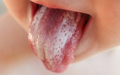 Про що говорить появою білого нальоту на поверхні язика?