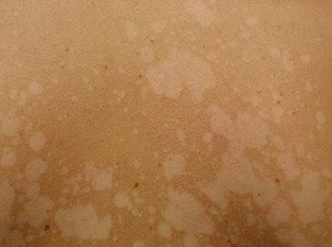 Чому на шкірі зявляються білі плями: як позбутися білих плям на тілі