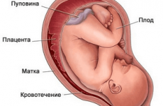 Ретрохориальная гематома при вагітності