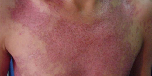 Гранульома шкіри: причини, стадії появи, види, лікування