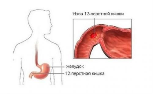 Болю при виразці шлунка: як болить, симптоми, які можна пити знеболюючі