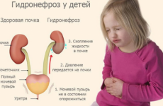 Гідронефроз у дітей — вроджене захворювання у новонародженого