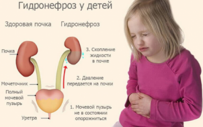 Гідронефроз у дітей — вроджене захворювання у новонародженого