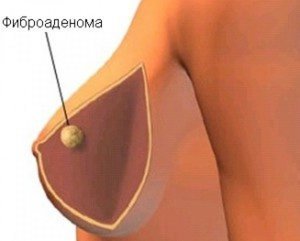 Ліпома грудної молочної залози у жінок і чоловіків: причини, ознаки і лікування жировика