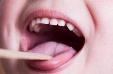 Прищі на язиці у дитини – як позбутися і швидко прибрати? Причини і лікування. Фото, відео.