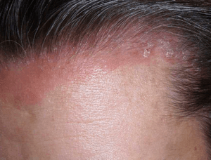 Як лікувати псоріаз волосистої частини голови: стадії, симптоми та причини