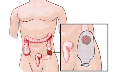 Особливості формування колостом при різних патологіях кишечника