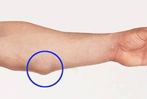 Жировик на руці під шкірою: як швидко позбутися, видалення