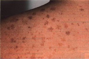 Темні і світлі коричневі плями на шкірі: причини пігментації на тілі людини, діагностика та профілактика