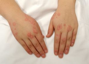 Висип на руках у вигляді червоних плям і крапок: причини появи висипань, лікування і профілактика, відгуки