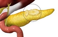 Чим зумовлений розвиток ліпоматозу в тканинах підшлункової залози