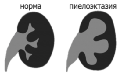 Піелоектазія нирок при вагітності: розширена балія правої або лівої нирки