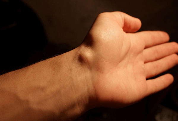 Жировик на руці під шкірою: як швидко позбутися, видалення