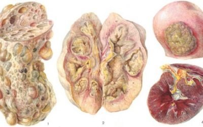 Туберкульоз нирок | Симптоми і лікування нирки у дорослих і дітей