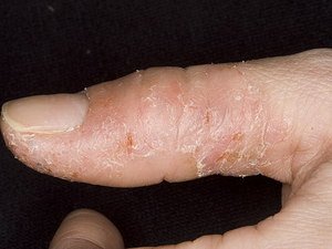 Лікування грибка між пальцями рук медичними і народними засобами; кандидоз та інші види грибка