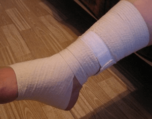 Гематома на нозі після удару: причини і симптоми, лікування