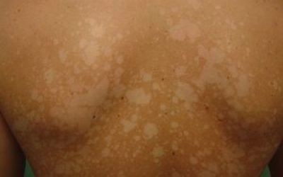 Як вилікувати сонячний грибок на шкірі у людини, позбавляючи профілактика