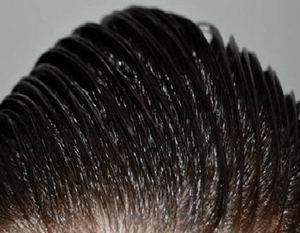 Жирна себорея шкіри голови: методи лікування
