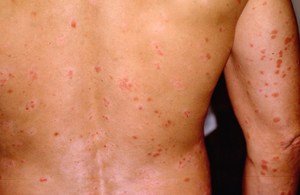 Плями на шкірі: як виглядають симптоми хвороб печінки, сірі і червоні плями, лікування хвороб печінки