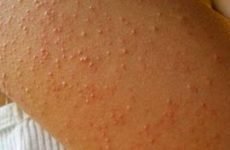 Фолікулярний гіперкератоз шкіри: причини, лікування, відгуки пацієнтів про захворювання
