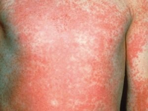 Причини і симптоми кропивянки у дорослих, як виглядає і чим лікувати алергічну кропивянку