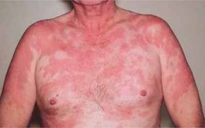 Туберкульоз шкіри: різновиди та перші ознаки та симптоми , правила лікування хвороби
