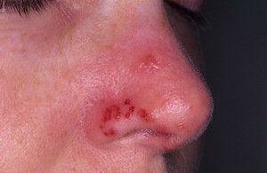 Причини появи герпесу на носі, симптоми і лікування застуди у дітей і дорослих