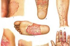 Що таке мікоз шкіри і як його лікувати: основні симптоми грибкового захворювання, лікування та профілактика