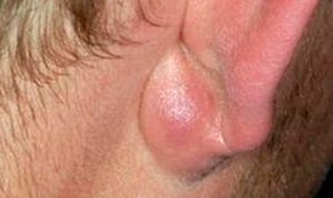 Освіта кульки у вигляді ущільнення всередині мочки вуха, причини виникнення і методи лікування