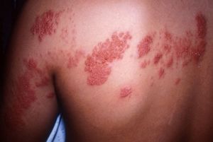 Оперізувальний лишай або герпес: симптоми захворювання, лікування шкірного захворювання в домашніх умовах