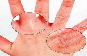 Лікування дерматиту на шкірі рук: симптоми захворювання, як виглядає, як лікувати