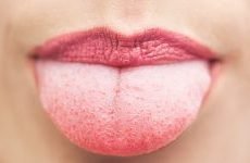 Прищі на язиці: причини і лікування. Як позбутися від білих або червоних прищів на язиці ближче до горла