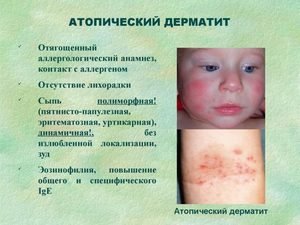 Атопічний дерматит у дорослих: причини, симптоми, лікування препаратами і народними засобами