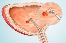 Пухлина сечового міхура у жінок: симптоми і прогноз раку, види лікування