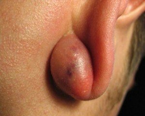 Освіта кульки у вигляді ущільнення всередині мочки вуха, причини виникнення і методи лікування