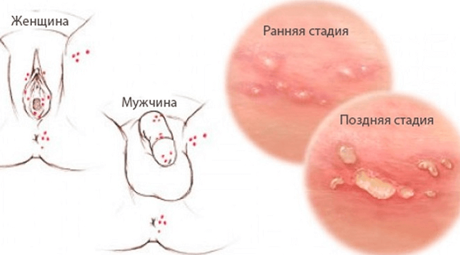 Вірус папіломи на статевих губах у жінок: видалення і лікування