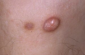 Різновиди фіброми шкіри: причини виникнення, симптоми, прояв мяких і твердих утворень