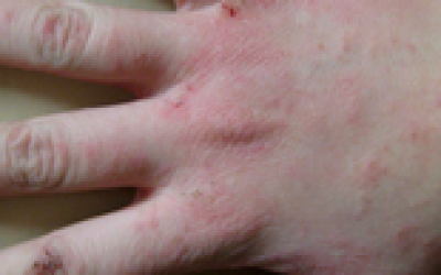 Алергія на руках від миючих засобів: між пальцями, симптоми, причина та лікування