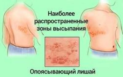 Оперізувальний лишай або герпес: симптоми захворювання, лікування шкірного захворювання в домашніх умовах