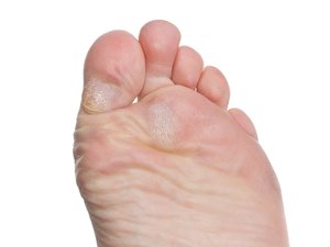 Чому утворюються сухі мозолі на пальцях ніг і як їх прибрати, способи лікування і видалення