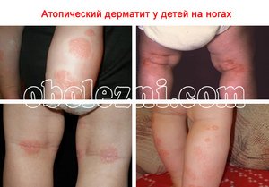 Дитячий атопічний дерматит: причини і симптоми у дитини, лікування алергії у немовляти за Комаровським