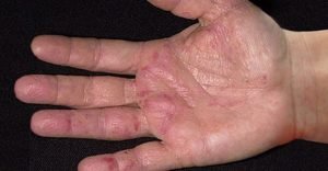 Лікування дерматиту на шкірі рук: симптоми захворювання, як виглядає, як лікувати
