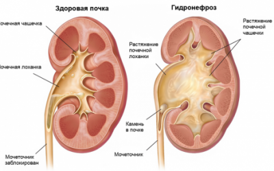 Піелоектазія нирок — що це таке | Розширення балії правої і лівої нирки