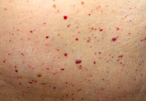 Гемангіома на шкірі у дорослих: причини, види, лікування, рецепти