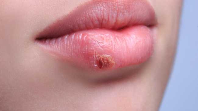 Герпес на губі: лікування, причини, симптоми, народні методи